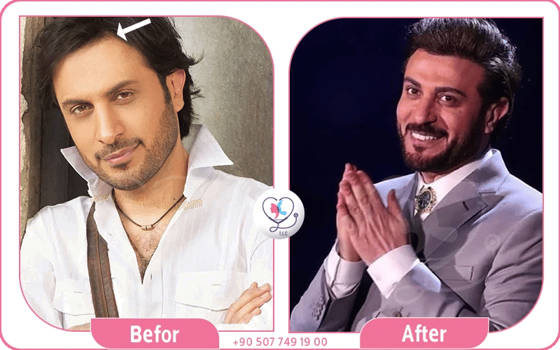 نصائح للحفاظ على نتائج زراعة الشعر نصائح للحفاظ على نتائج زراعة الشعر