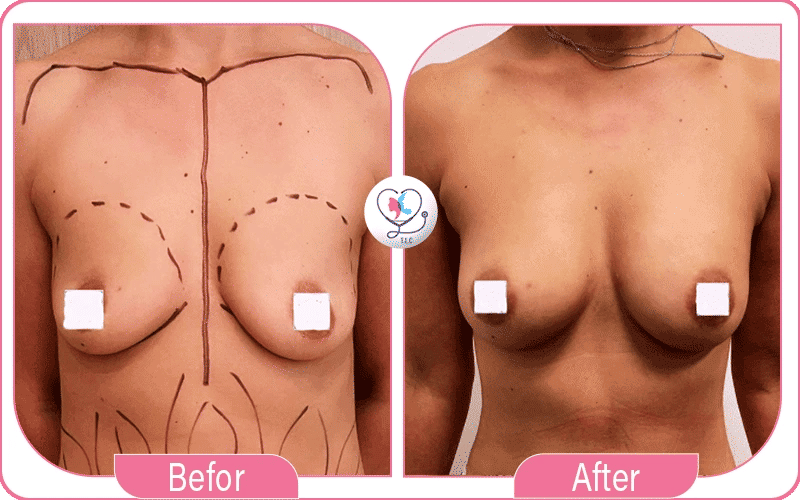 Quels sont les résultats d’un lipofilling mammaire