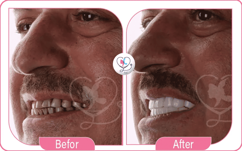 تكلفة زراعة الأسنان