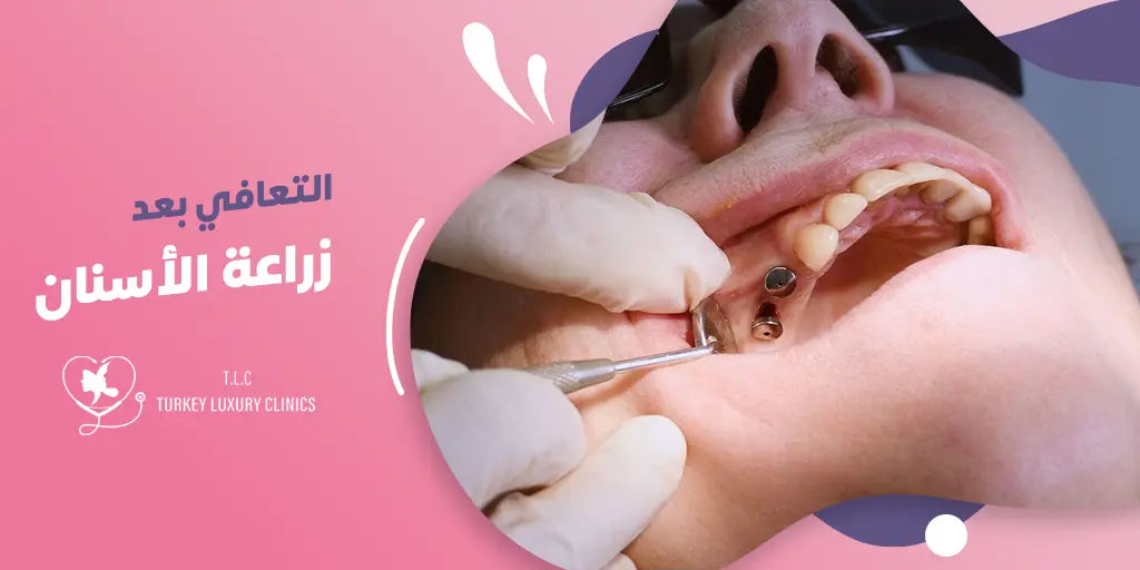 التعافي بعد زراعة الأسنان
