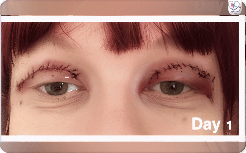 Blépharoplastie après 2 jours