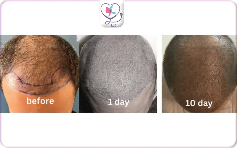 À quoi ressemble la zone transplantée 10 jours après