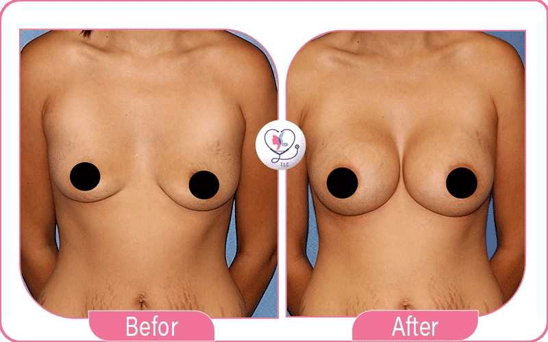 فترة التعافي في تجربتي في شد الثدي