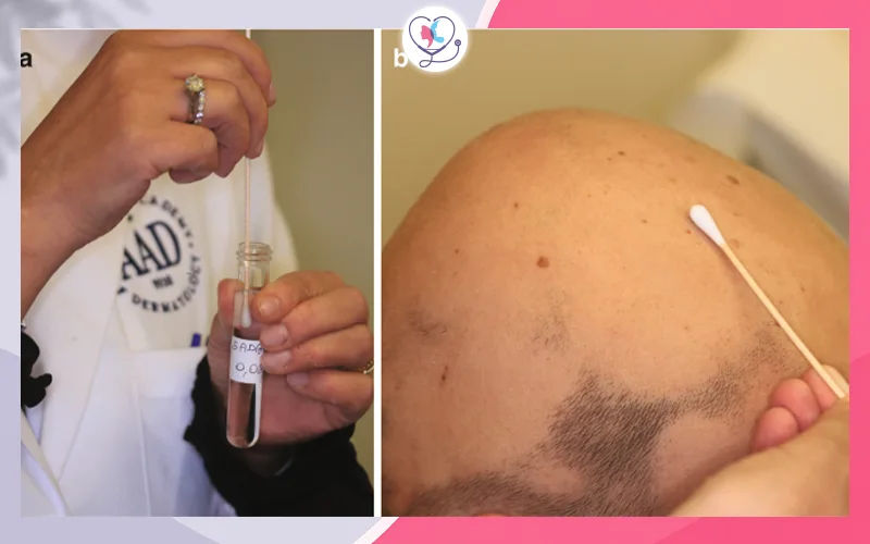 العلاج المناعي الموضعي (Topical Immunotherapy)