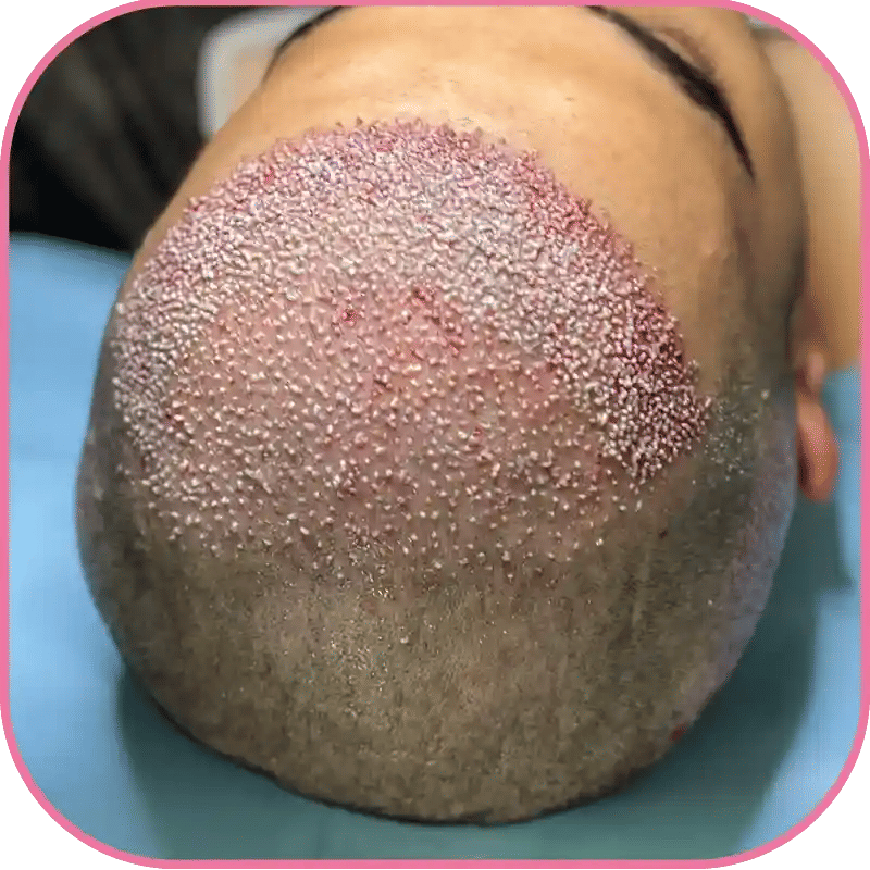 Hair Transplant for Thinning Edges