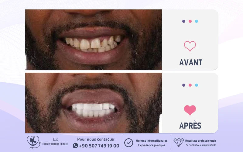 Photos avant et après des dents d’un patient
