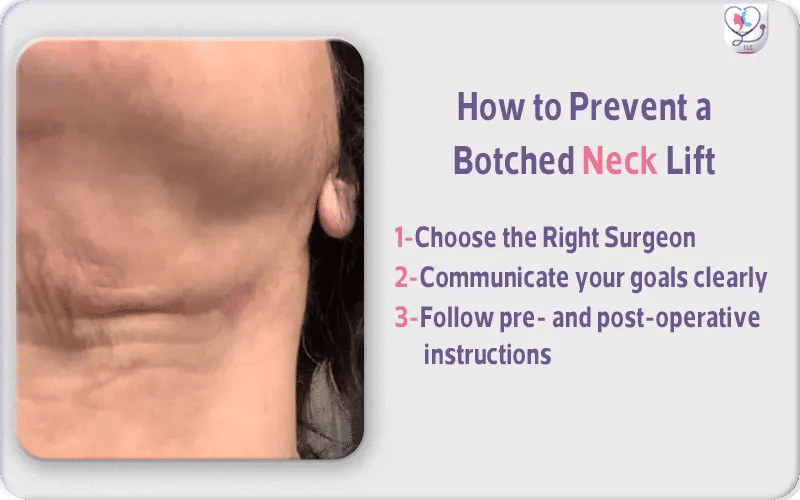 How to Prevent a Botched Neck Lift