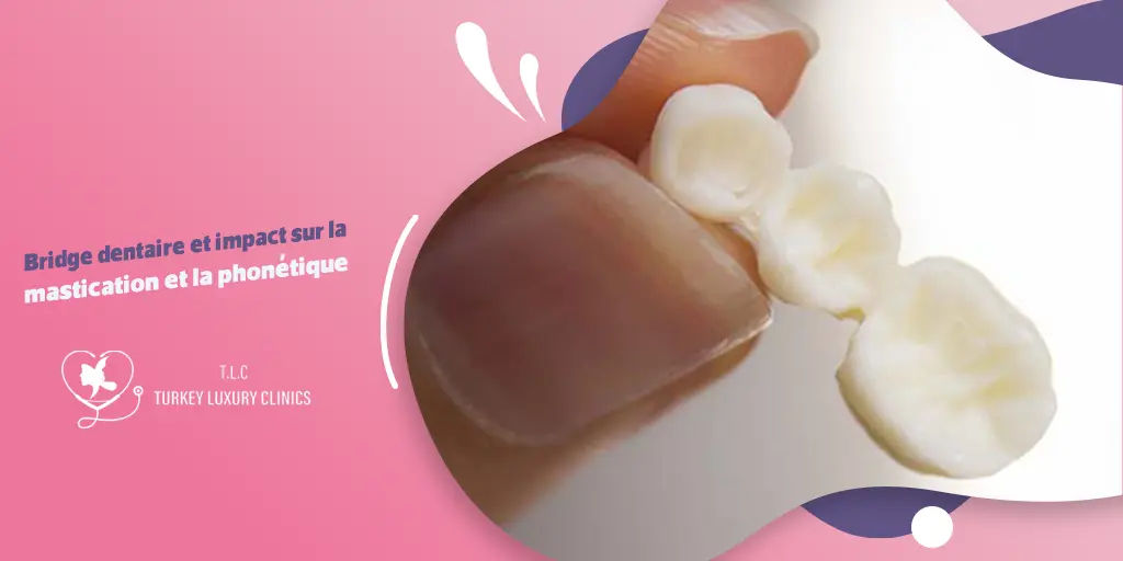 Bridge dentaire et impact sur la mastication et la phonétique