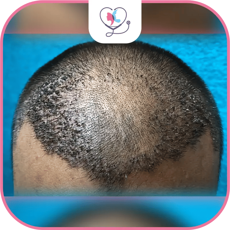 Hair Transplant Shock Loss Photos