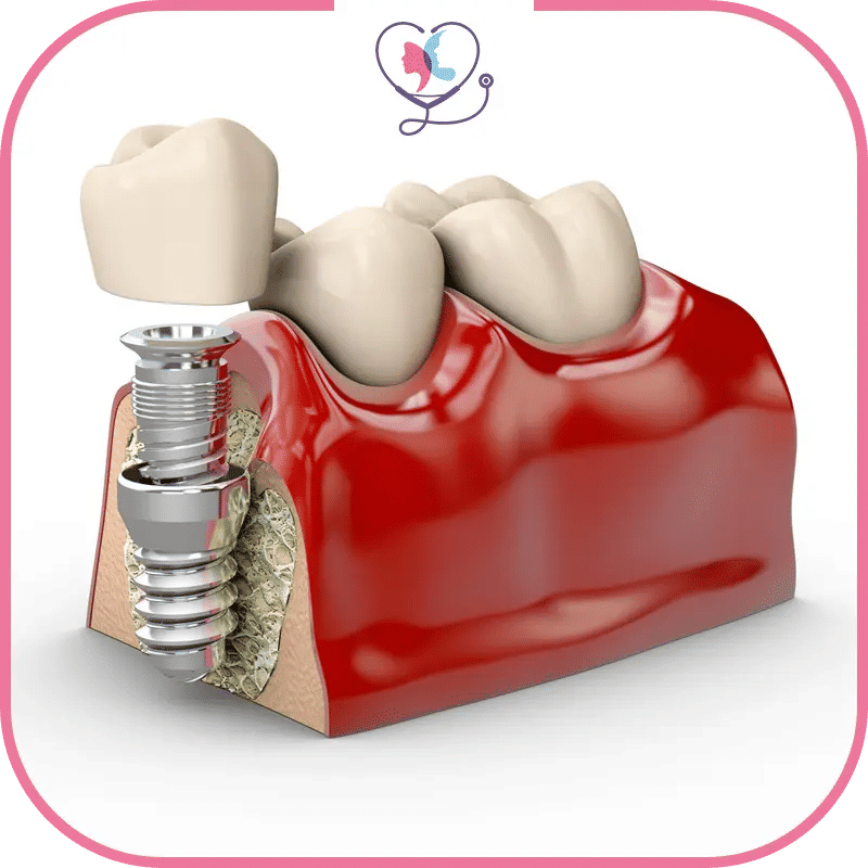 ما هي زراعة الأسنان الفورية؟