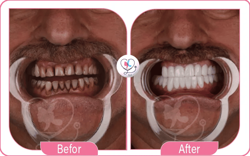 أسعار زراعة السن الواحد