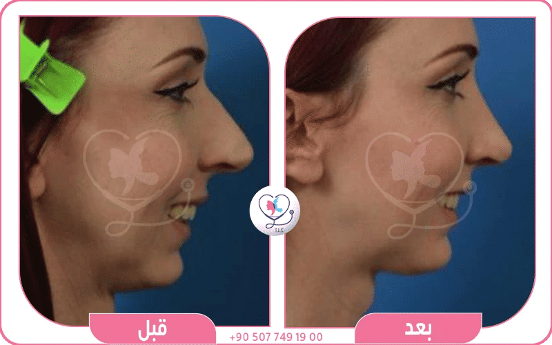 تصغير الانف الكبير
