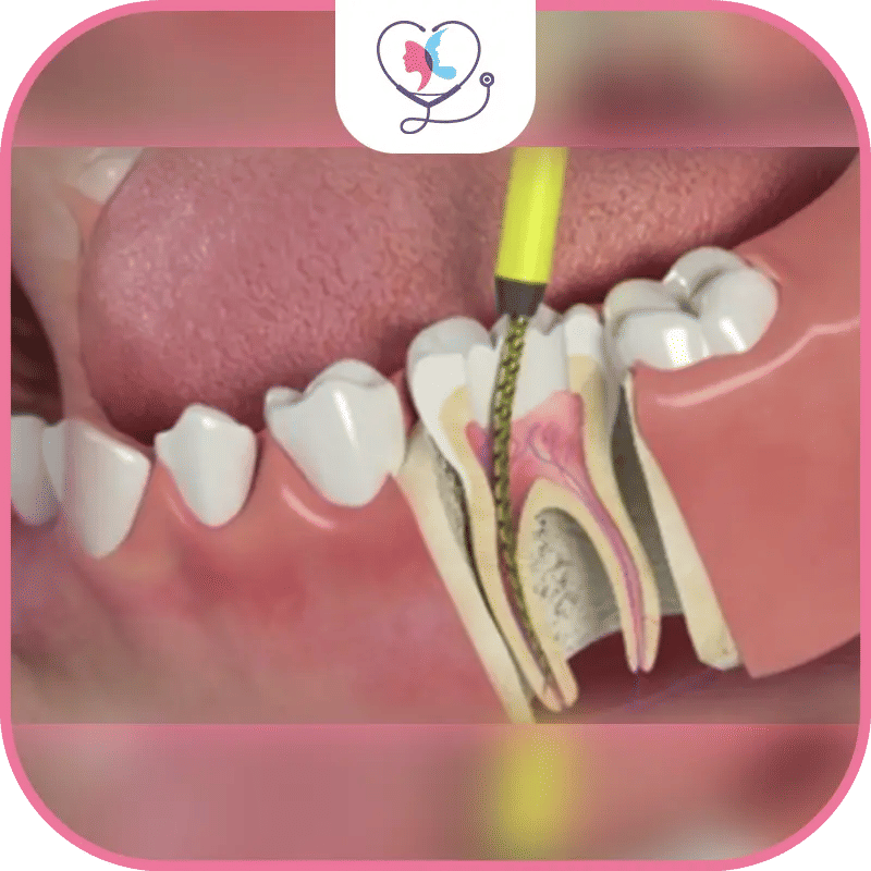 خراج الاسنان: الأعراض، الأسباب، وطرق العلاج الفوري لتجنب المضاعفات