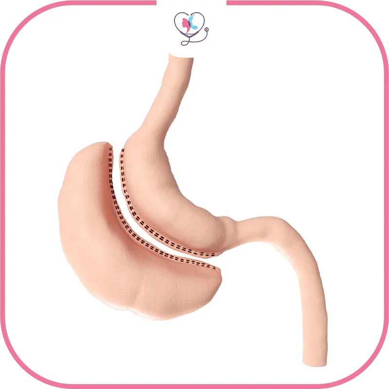 comparaison-du-coût-de-la-sleeve-gastrique-en-turquie-vs-france