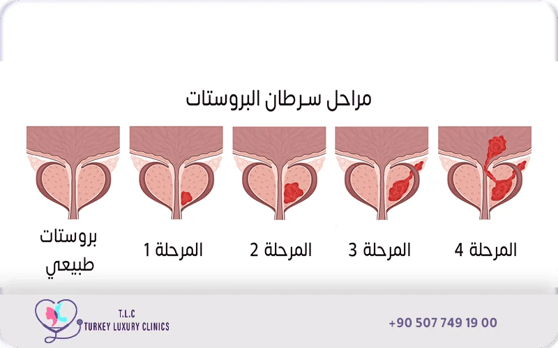علاج سرطان البروستاتا حسب المراحل