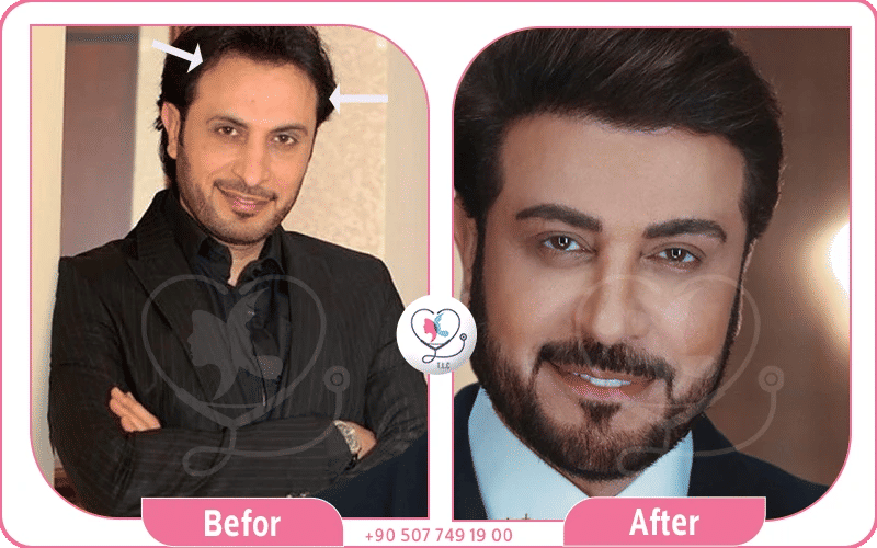 صور ماجد المهندس قبل وبعد الزراعة صور ماجد المهندس قبل وبعد الزراعة