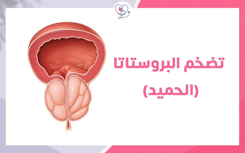 شكل تضخم البروستاتا (الحميد)