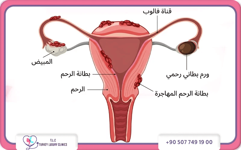 اعراض بطانة الرحم المهاجرة بحسب الدورة الشهرية