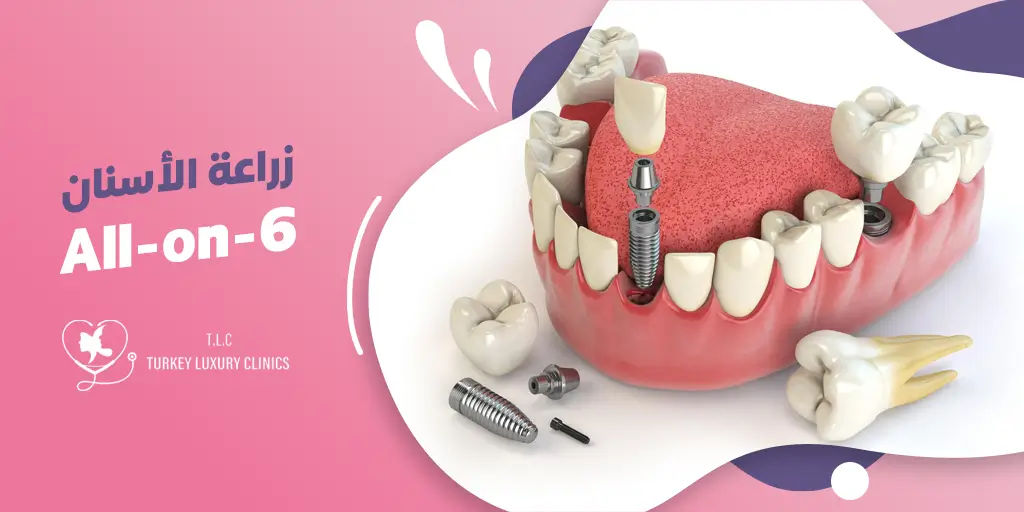 زراعة الأسنان All-on-6