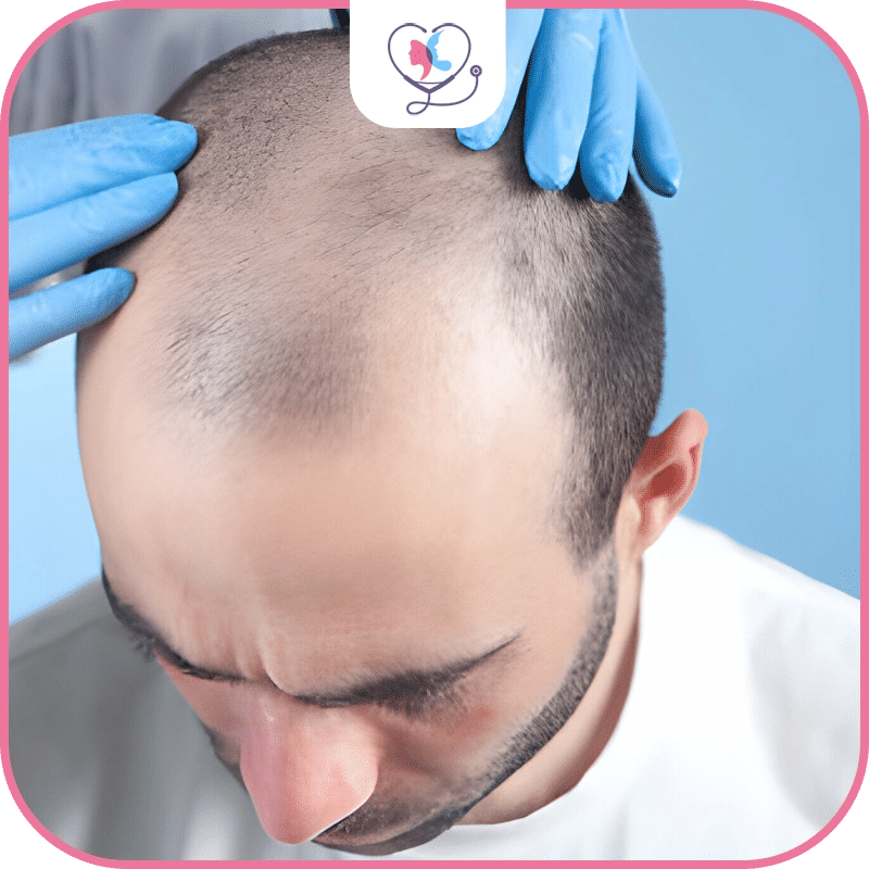 Les contre-indications relatives a la greffe de cheveux