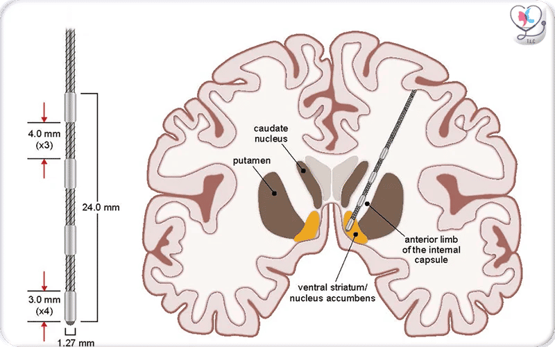 What is Deep Brain Stimulation Surgery? 5