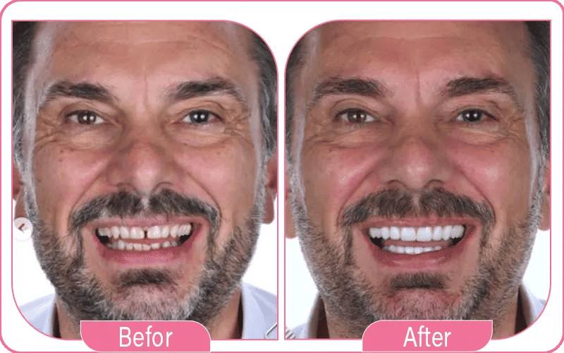 Emax Veneers in Turkey Before and After 3