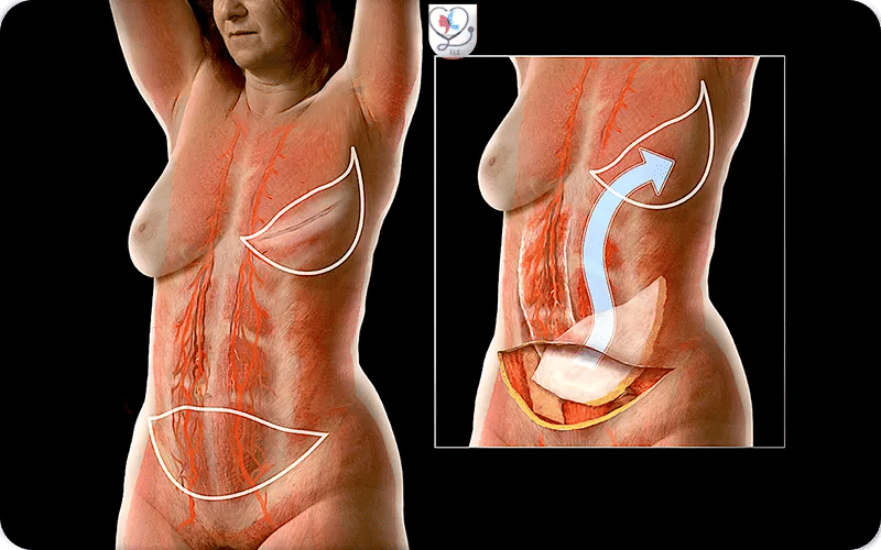 Les différentes techniques de reconstruction mammaire-2
