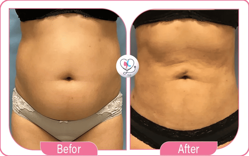 Liposuccion douce à l’étranger