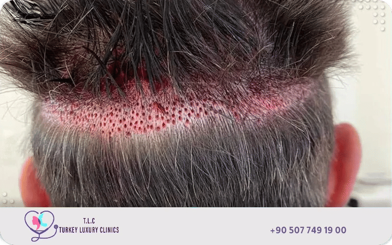 Back of scalp showing hair transplant donor area with FUE extraction marks in the occipital region