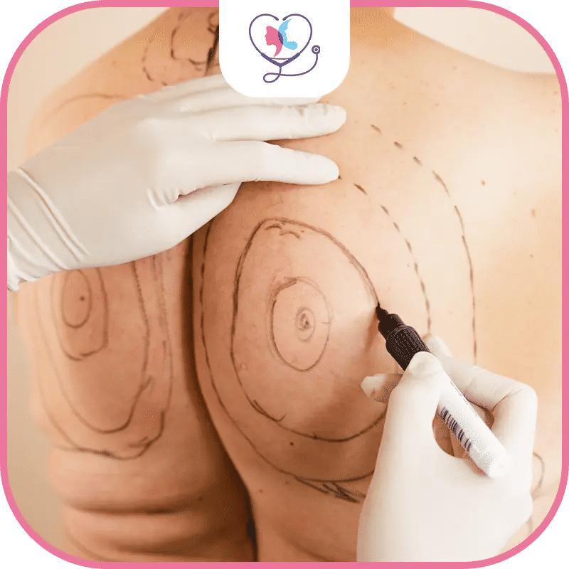 عملية شد الظهر في تركيا