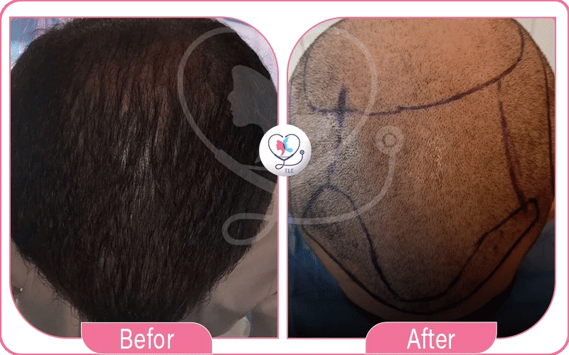 خامساً ضمان مدى الحياة