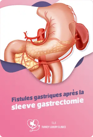 Fistules gastriques après la sleeve gastrectomie