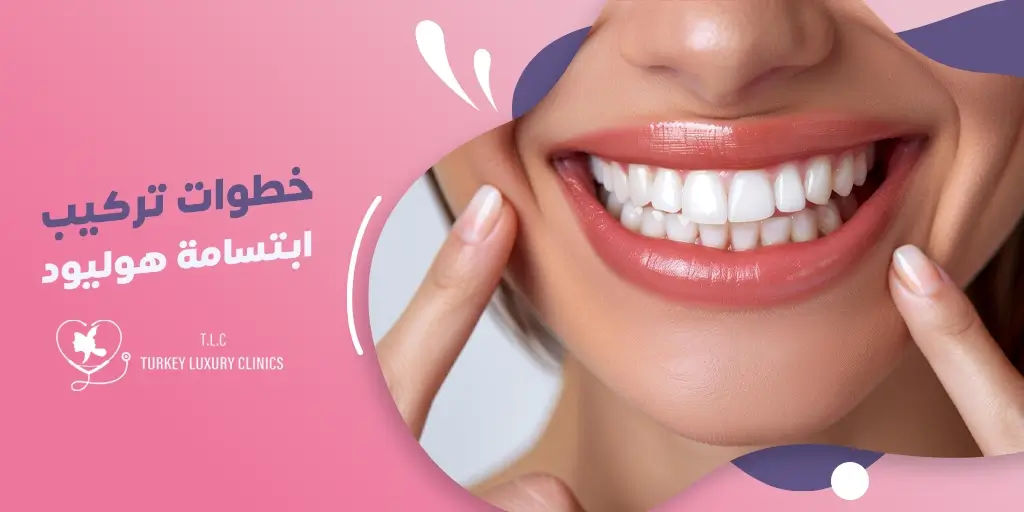 خطوات تركيب ابتسامة هوليود