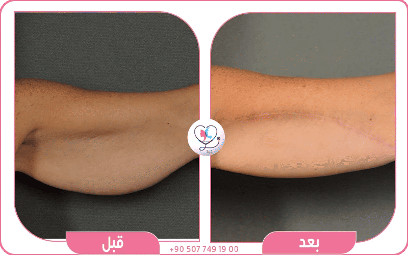 تنحيف الزنود تجربتي واختيار الطريقة المناسبة