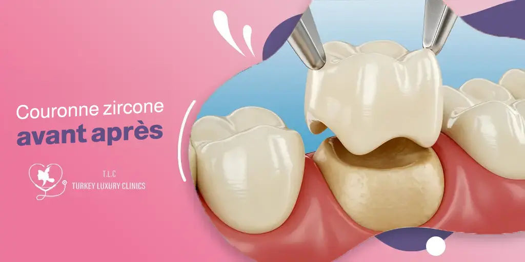 Couronne zircone avant après : transformation du sourire photos et résultats