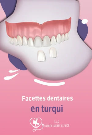 Facettes dentaires en turqui : Types, Prix, Avantages et Avis Patients