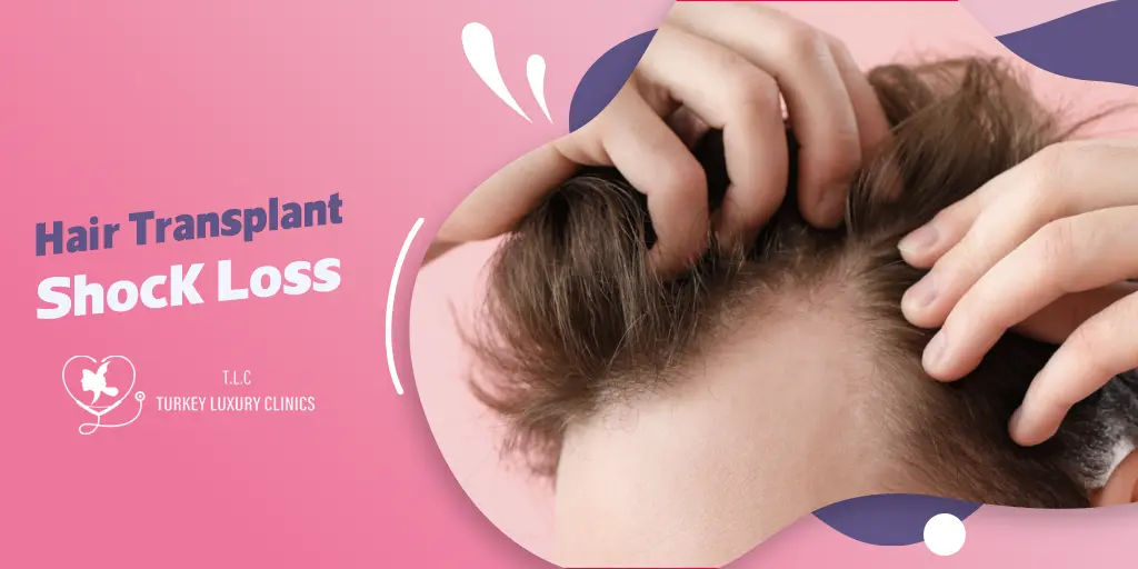 Hair Transplant Shock Loss