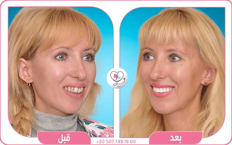 اتساع الابتسامة وبروز الشفاه
