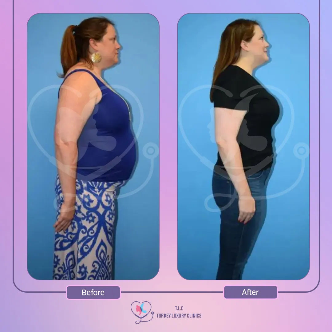 How Long Does Gastric Sleeve Procedure Take with Results