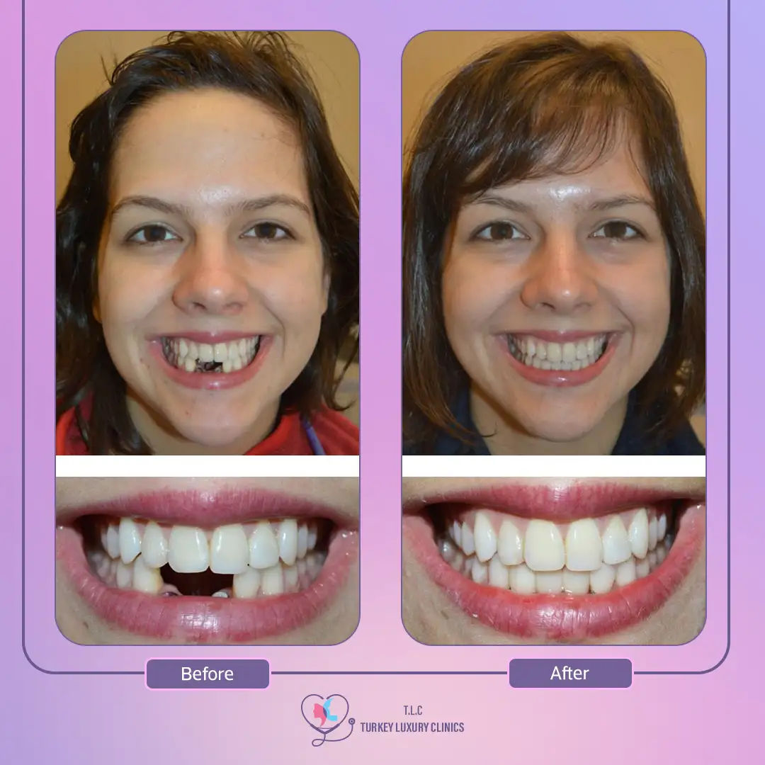 Prix d'un bridge dentaire en Turquie : Coûts, matériaux et devis [Mise à jour 2025]