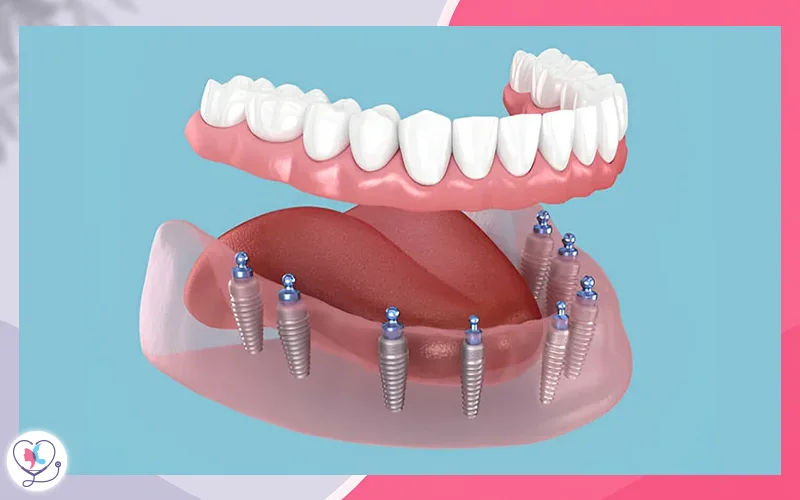 All-on-8 Dental Implants