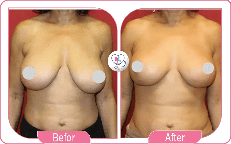 اختاري تركيا لاكشري كلينك لعمليات شد الثدي