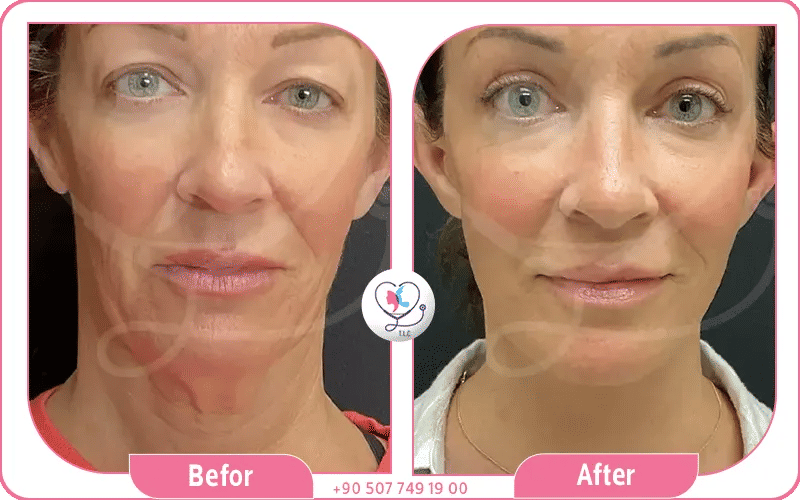 لماذا تختار تركيا لإجراء عملية شد الوجه؟