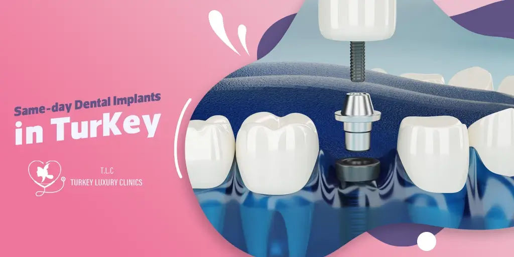 Same-day Dental Implants in Turkey – Fast & Affordable Solutions