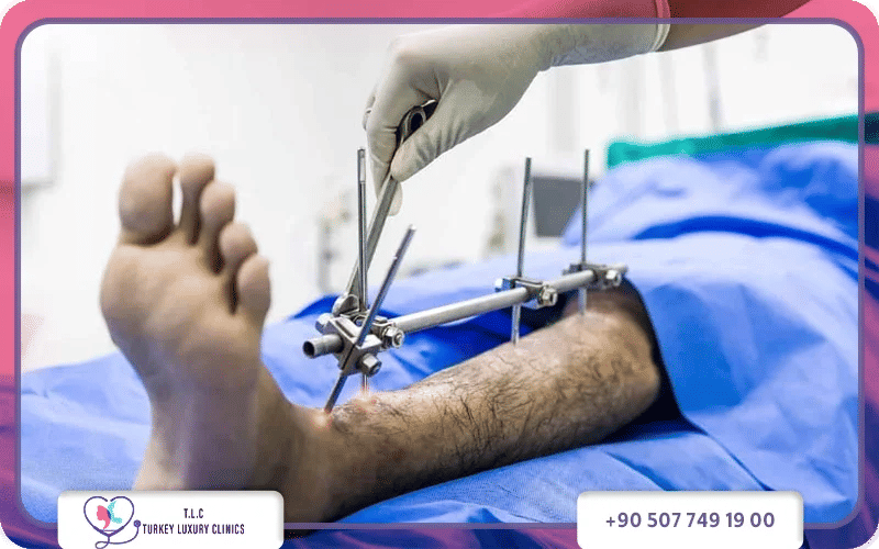 Who is a Limb Lengthening Surgeon?.