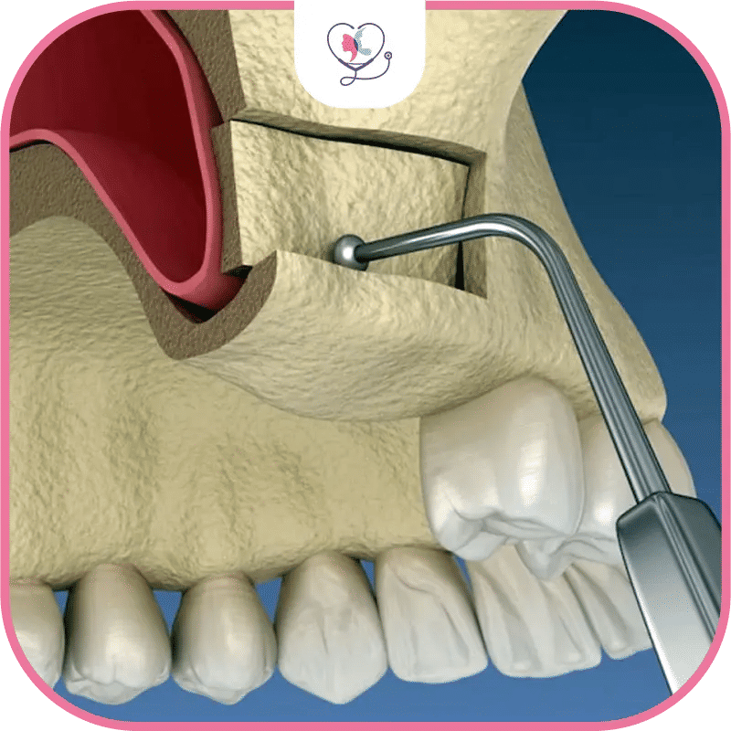 What is the Purpose of a Sinus Lift?