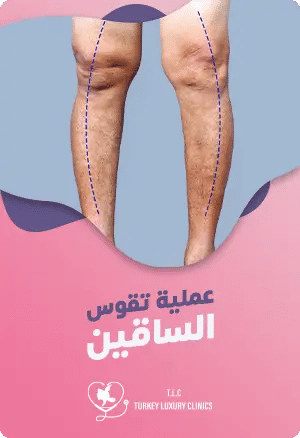 عملية تقوس الساقين في تركيا: الدليل الشامل