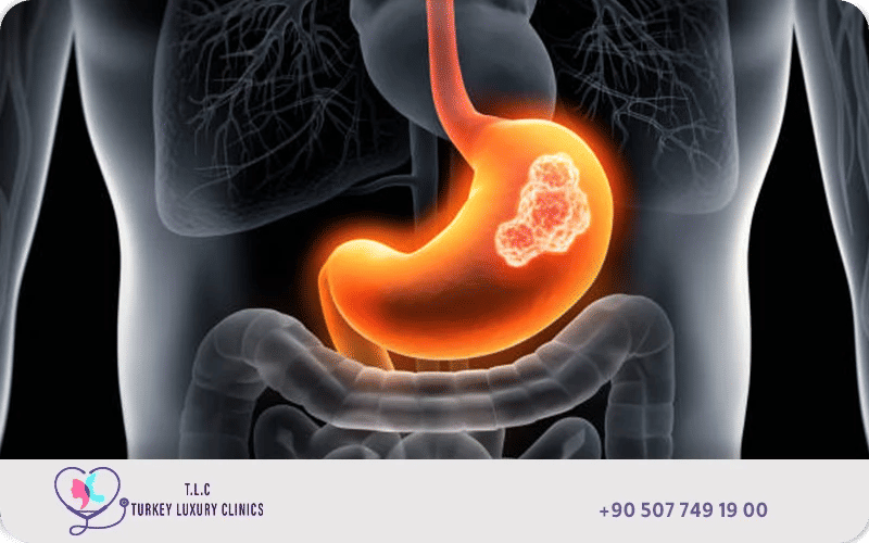 هل عملية استئصال المعدة خطيرة؟