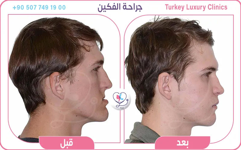 جراحة الفكين قبل وبعد
