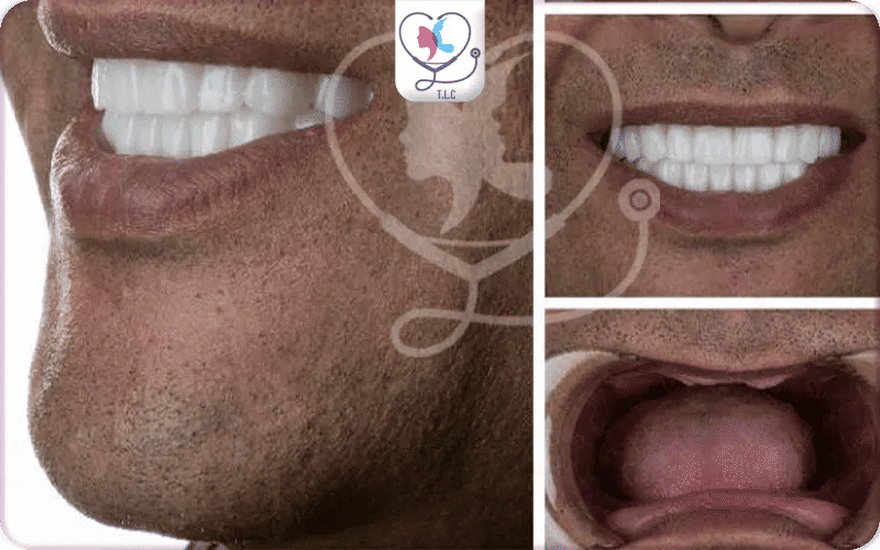 Best All on 6 Dental Implants in Turkey